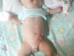Amriansyah, Bayi Lahir Tanpa Anus Ini Butuh Tindakan Medis